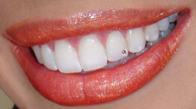 tooth piercing with a tooth gem